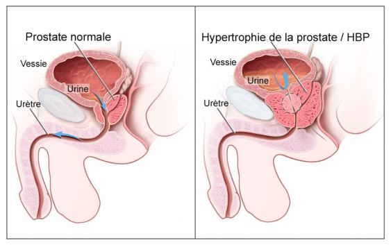 Prostate: La prévention c’est bon… Prostate: La prévention c’est bon…